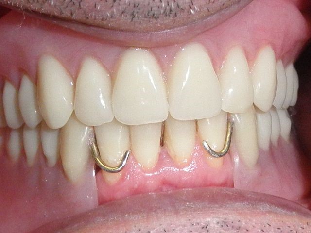 Implants Dentures Augusta NJ 7822